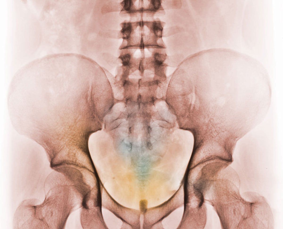 bekkenxraybasiscoloured1scaled